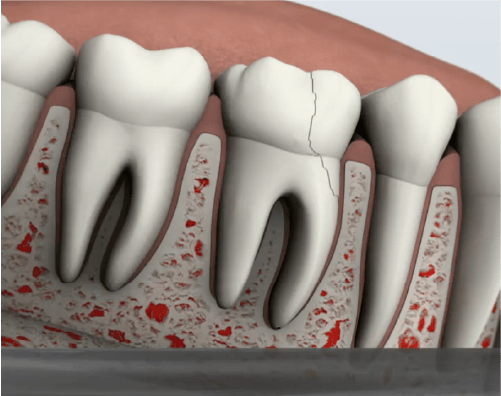 Cracked Tooth